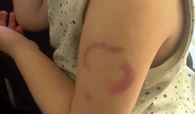 Öğretmen 3 yaşındaki öğrencisini ısırdı