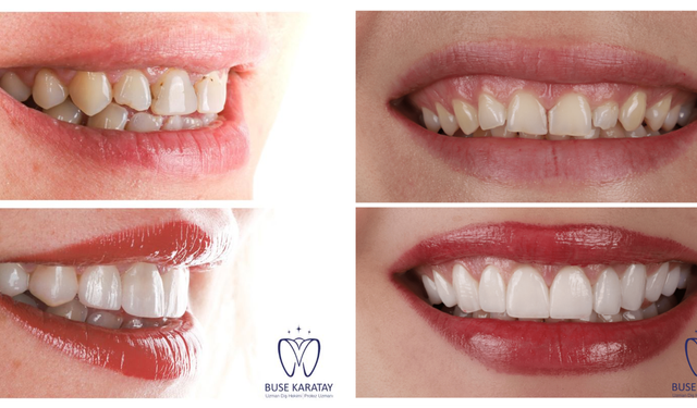 Porselen Diş uygulamaları güvenli mi?